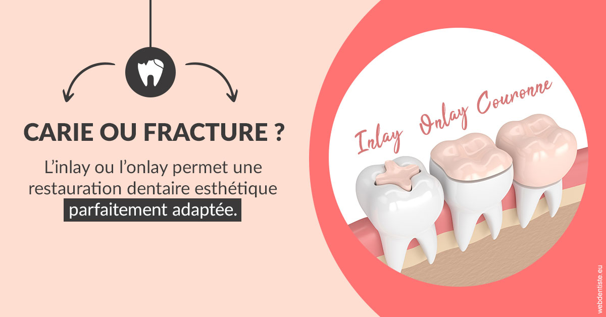 https://dr-brenda-mertens.chirurgiens-dentistes.fr/T2 2023 - Carie ou fracture 2