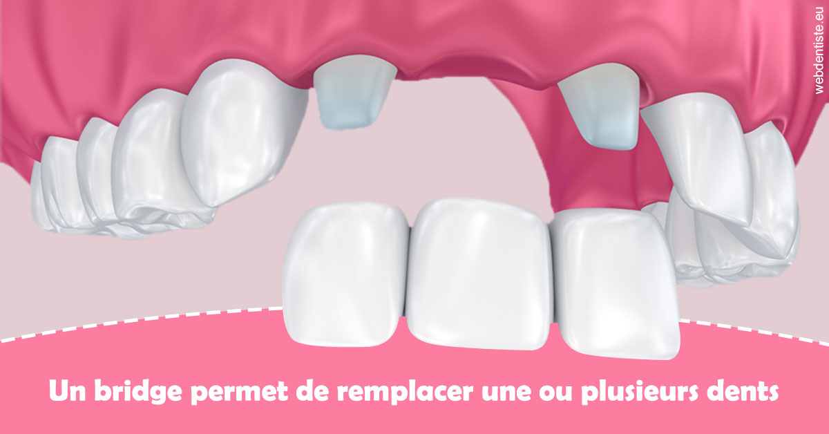 https://dr-brenda-mertens.chirurgiens-dentistes.fr/Bridge remplacer dents 2