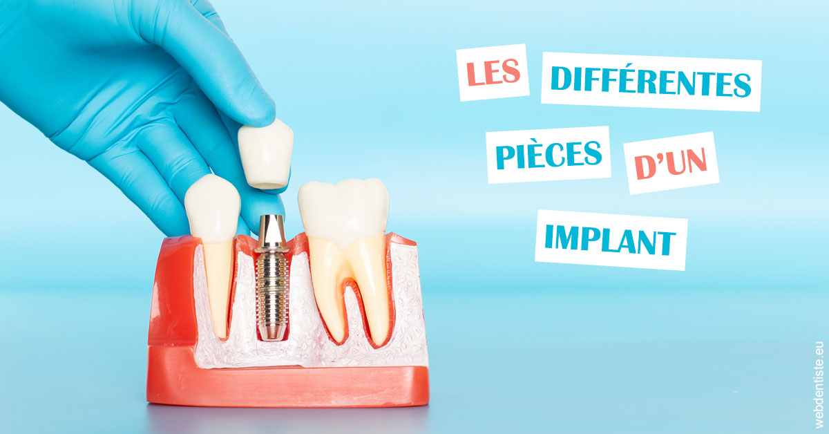 https://dr-brenda-mertens.chirurgiens-dentistes.fr/Les différentes pièces d’un implant 2